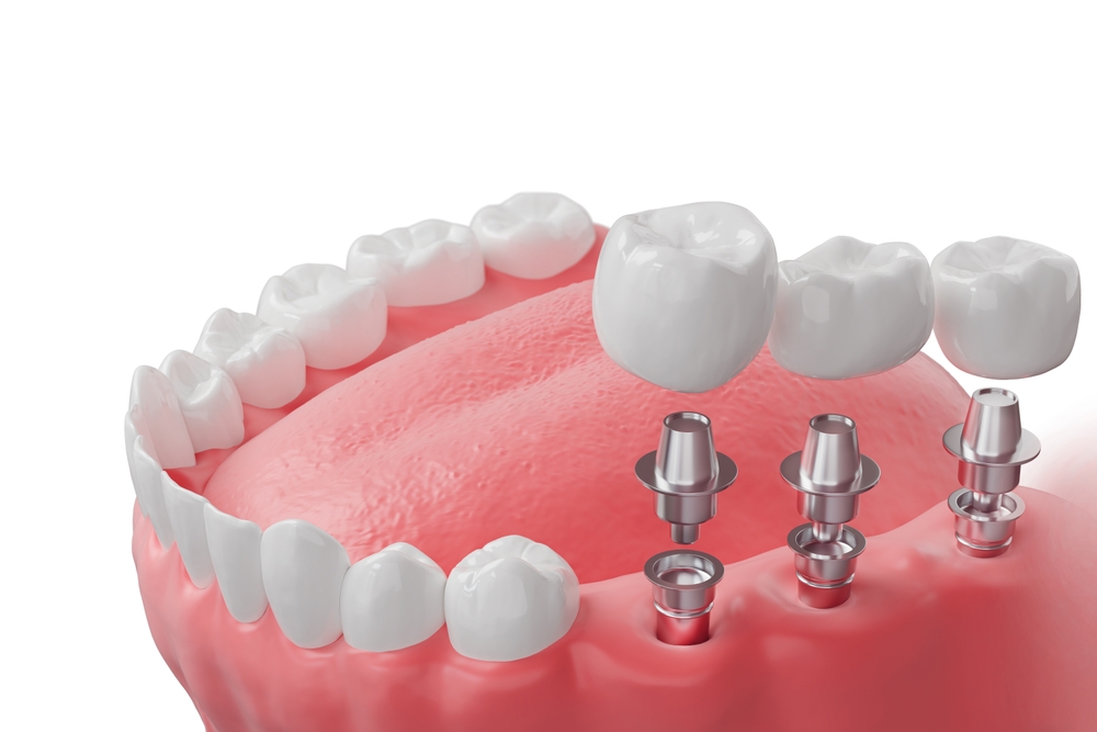 dental implants what the process looks like from first consult to final crown
